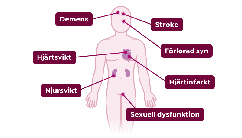 En illustration på en kropp med pilaar som visar vilka olika sjukdomar man kan få om man inte behandla ett högt blodtryck
