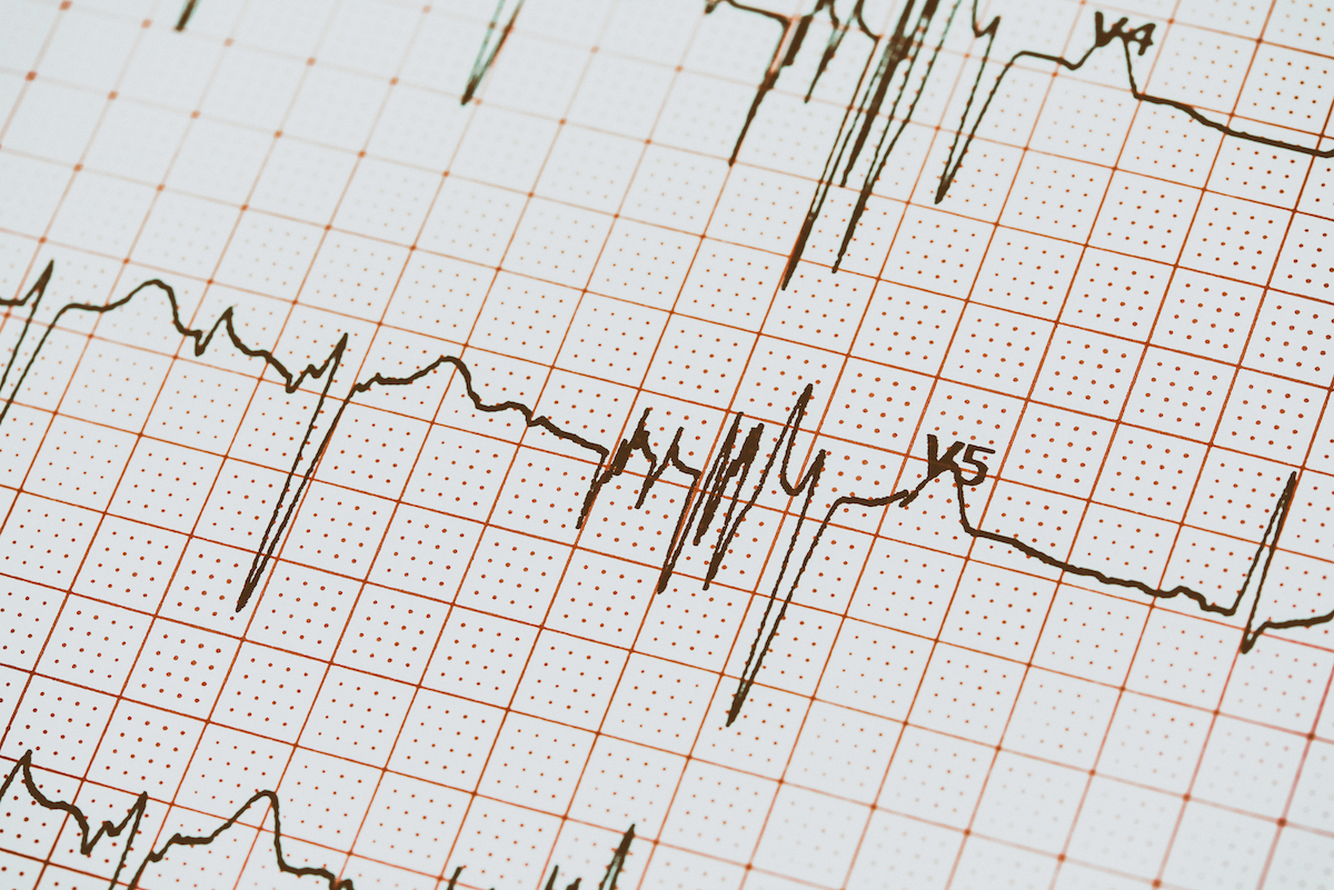 An EKG drawing showing the electrical activity of a heart. The graph displays a series of peaks and valleys that represent the heart's electrical impulses as it beats